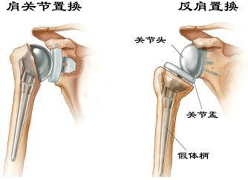 【新突破】黔西南州人民医院关节外科成功实施多例“反式肩关节置换”手术