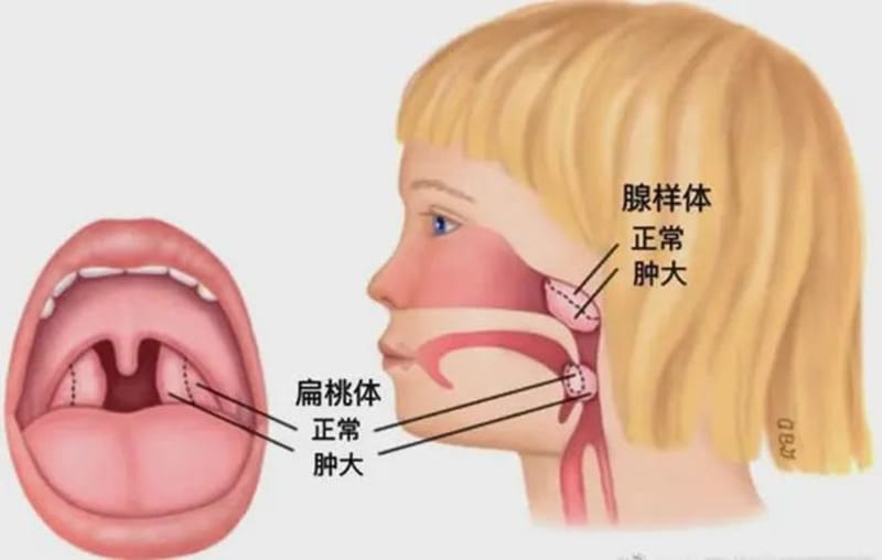 【州医科普】杨浩：小儿腺样体、扁桃体肥大要做手术吗？