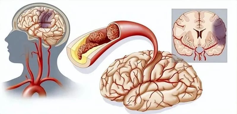 【州医科普】洪流：春季警惕脑梗找上门